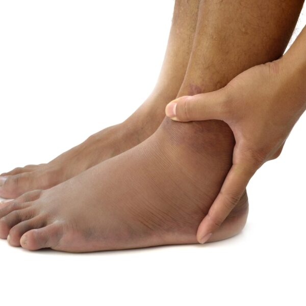 Effective Strategies to Reduce Swelling Quickly