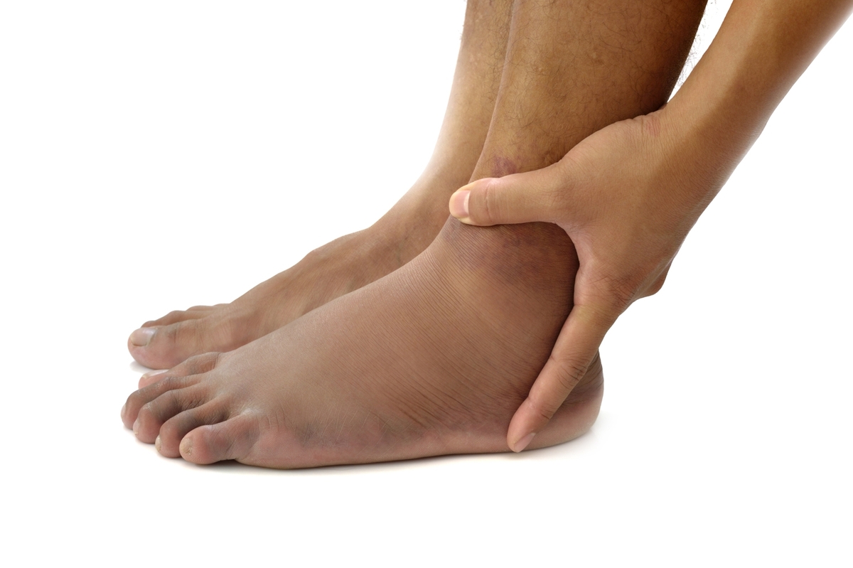 Effective Strategies to Reduce Swelling Quickly