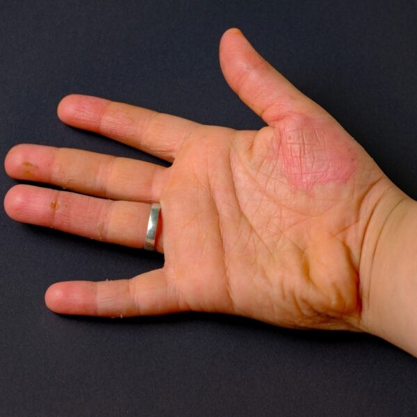 Understanding Dermatomyositis Symptoms: A Comprehensive Guide