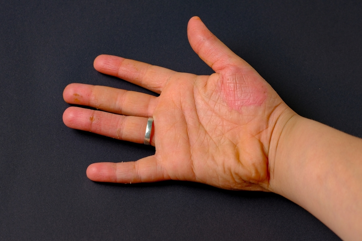 Understanding Dermatomyositis Symptoms: A Comprehensive Guide