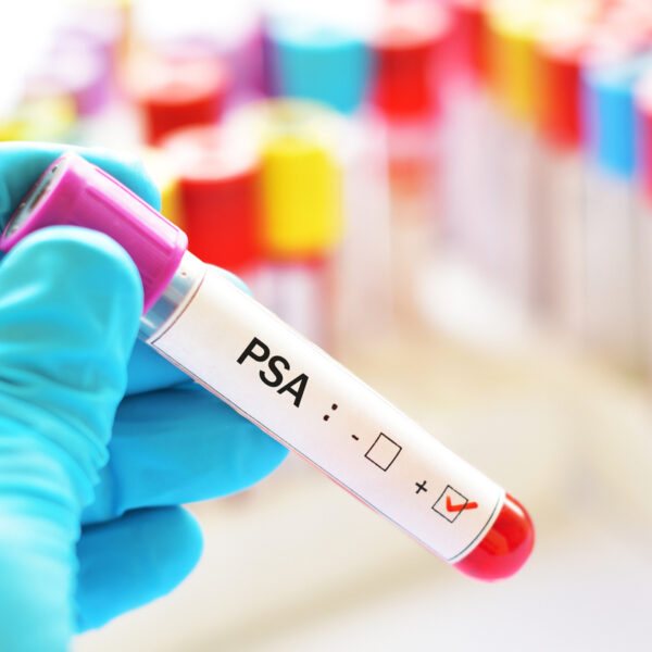 Understanding PSA Levels Over 60: What You Need to Know