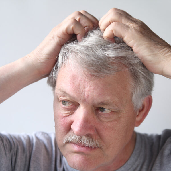 Understanding Plaque Psoriasis on the Scalp: Symptoms, Causes, and Treatment Options