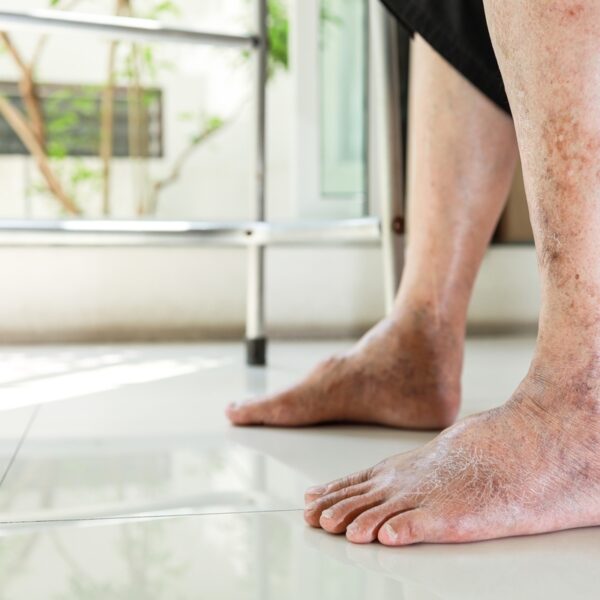 Understanding Psoriatic Arthritis in the Feet: Symptoms, Diagnosis, and Management