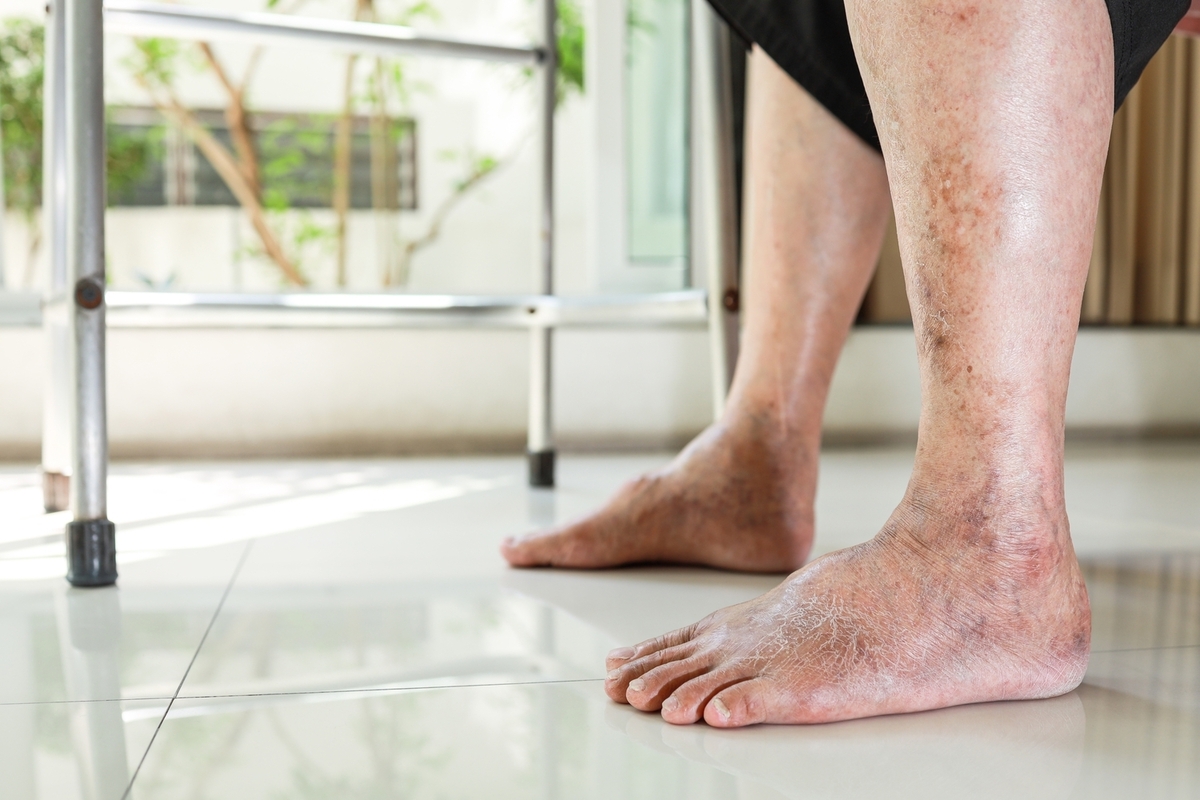 Understanding Psoriatic Arthritis in the Feet: Symptoms, Diagnosis, and Management