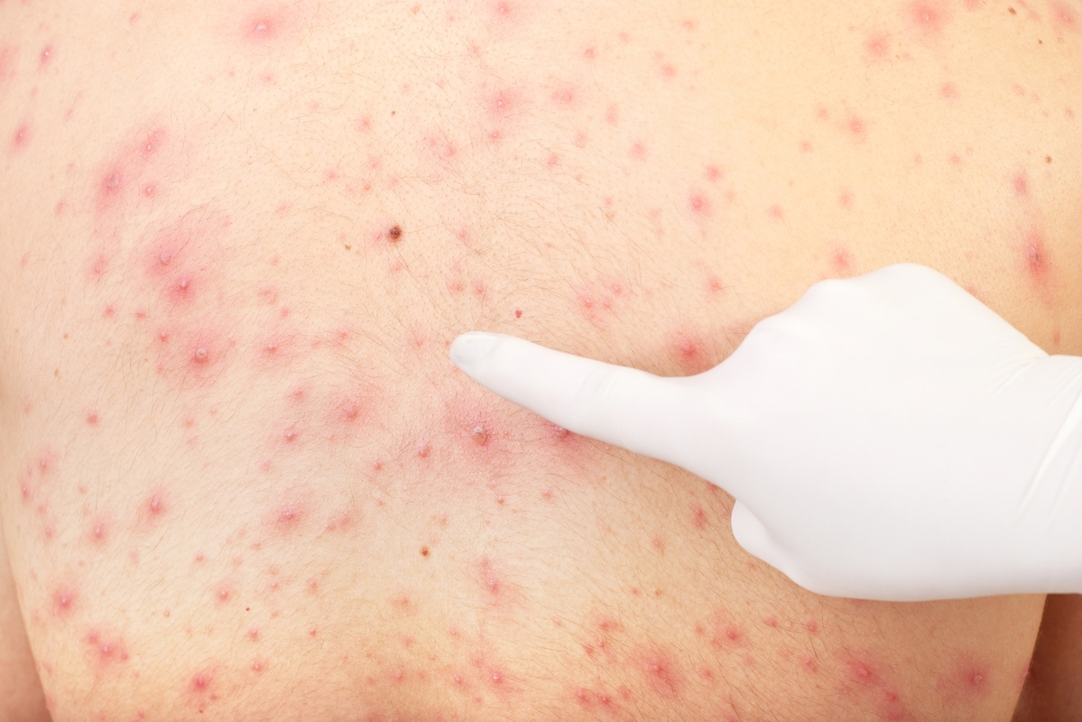 Understanding and Identifying Common Skin Rashes: A Visual Guide